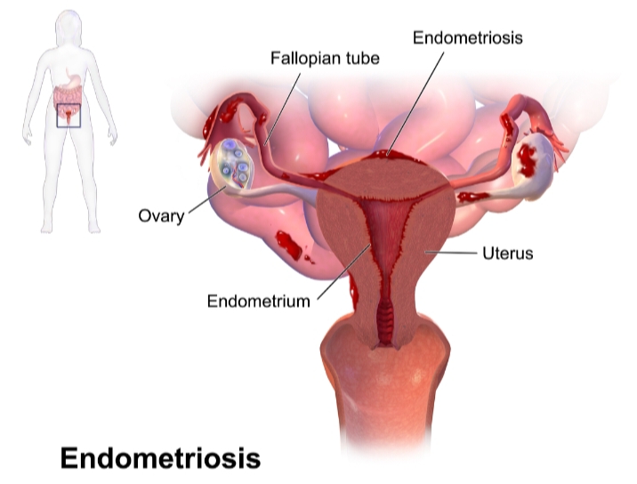 Image of the Female Reproductive System with Endometriosis