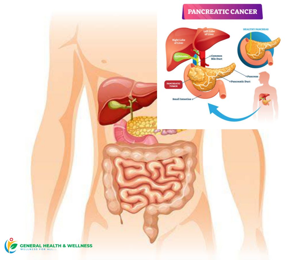 Pancreatic Cancer