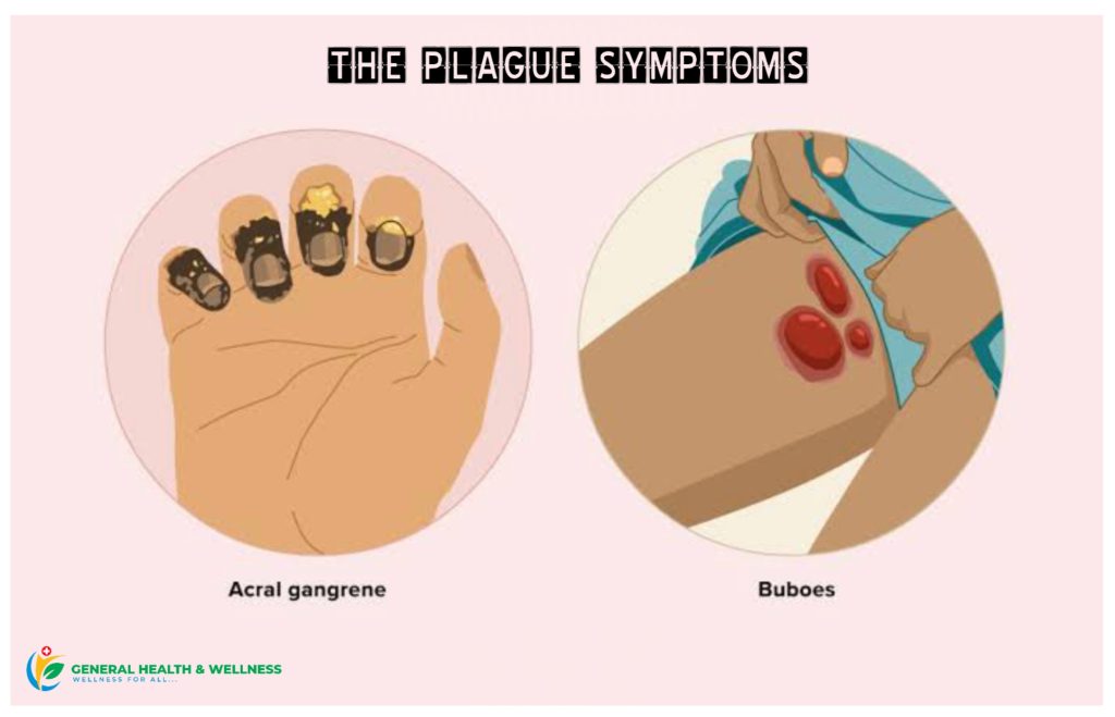 Symptoms Of Plague